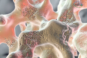 Osteoporoza kręgosłupa